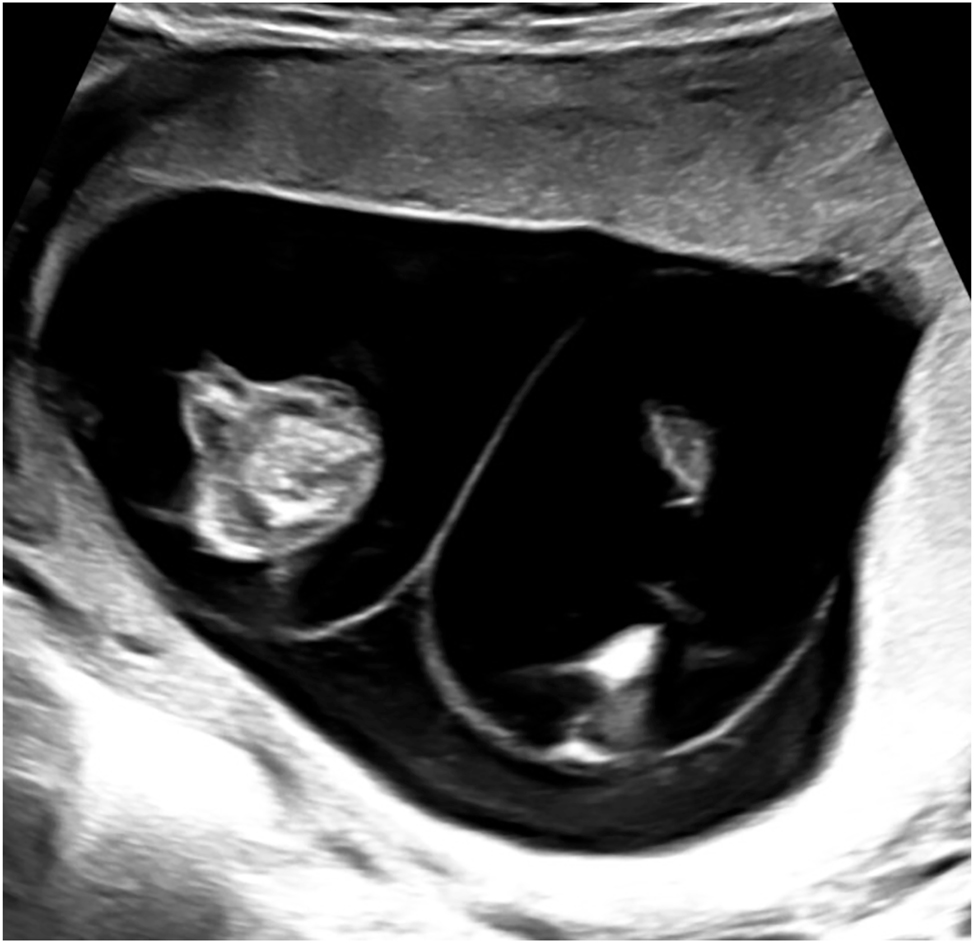 Figure 1: 
Sonographic image showing the interfetal membrane consisting of two amniotic layers appearing as “false lambda sign” in a monochorionic diamniotic twin pregnancy at 12 + 0 weeks of gestation.