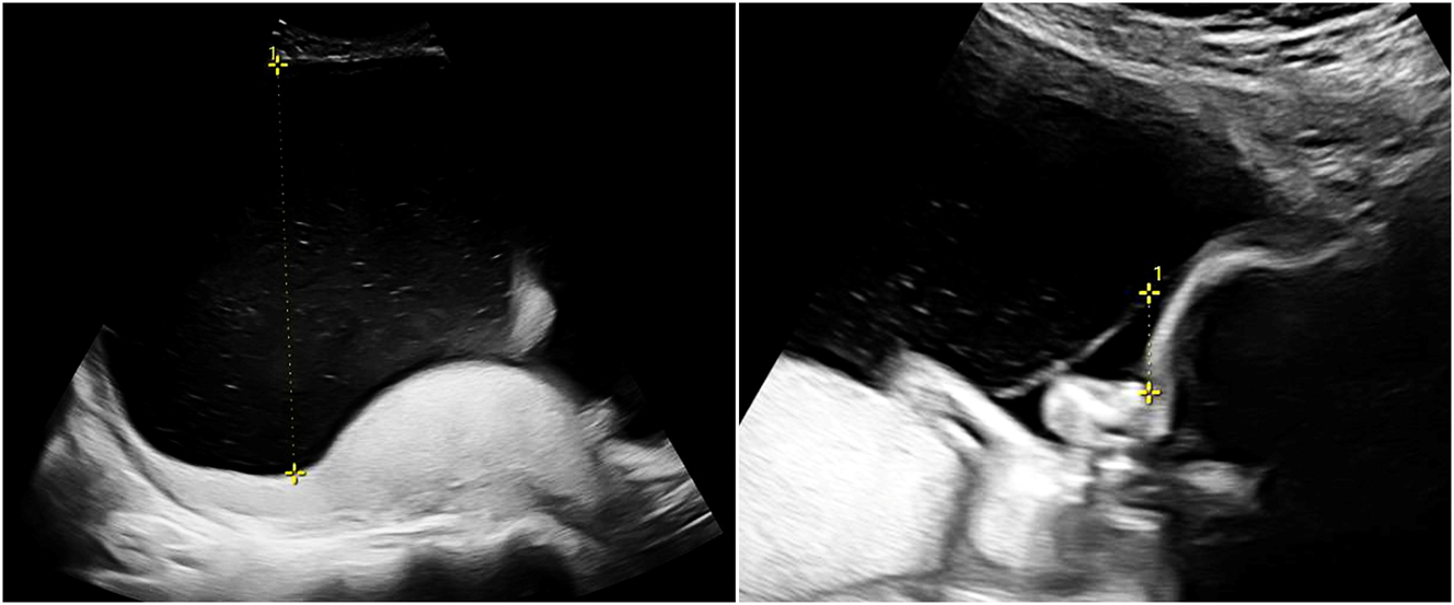 Figure 2: 
Sonographic image of TTTS (22 + 0 weeks) with polyhydramnios of 14 cm in the recipient (left) and oligohydramnios (1.6 cm) in the donor (right).