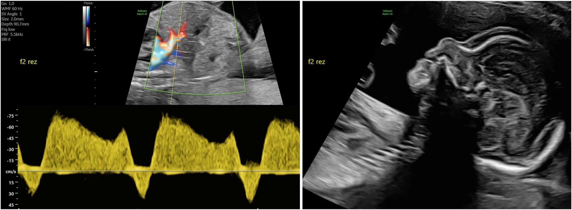 Figure 3: 
Sonographic image of a recipient (22 + 0 weeks, same as in Figure 2) with TTTS stage IV with abnormal ductus venosus flow (left) and skin edema (right).