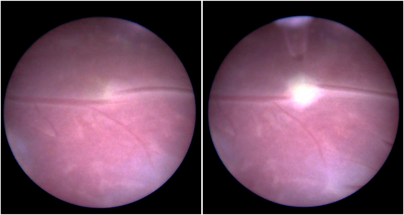 Figure 4: 
Fetoscopic image of an arterio-venous anastomosis before (left) and after (right) laser ablation. The donor artery originates from the right and connects into a recipient vein that leads to the left.
