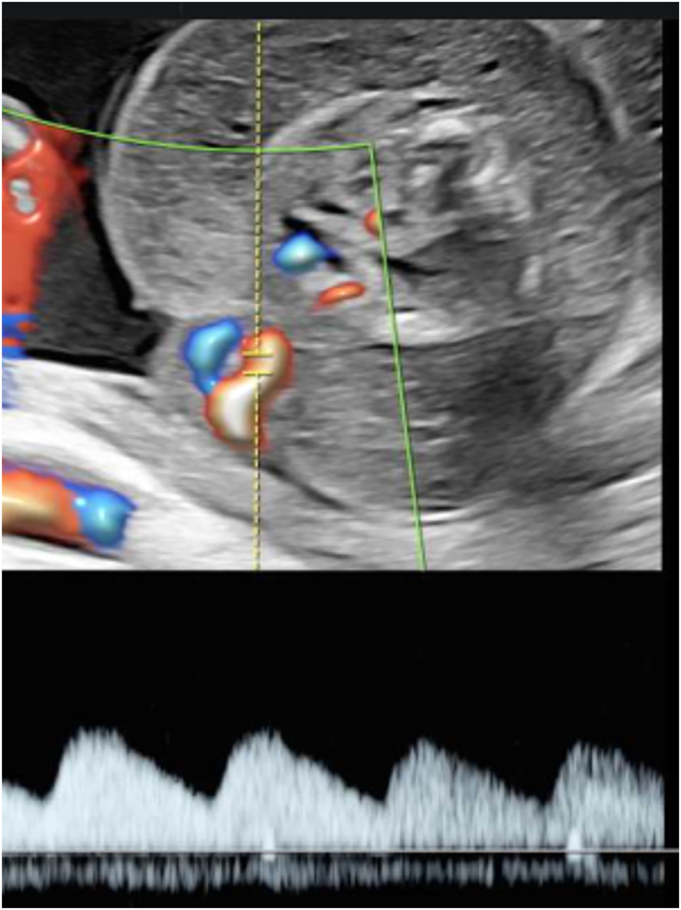 Figure 6: 
Sonographic image of a rudimentary TRAP fetus (22 + 4 weeks of gestation) with typical reversed arterial perfusion in the singular umbilical artery.