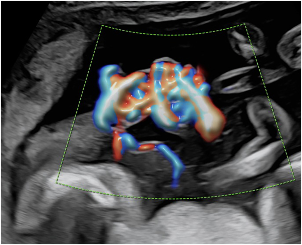 Figure 8: 
Color Doppler image of typical umbilical cord entanglement in a monochorionic-monoamniotic twin pregnancy at 17 + 2 weeks of gestation.