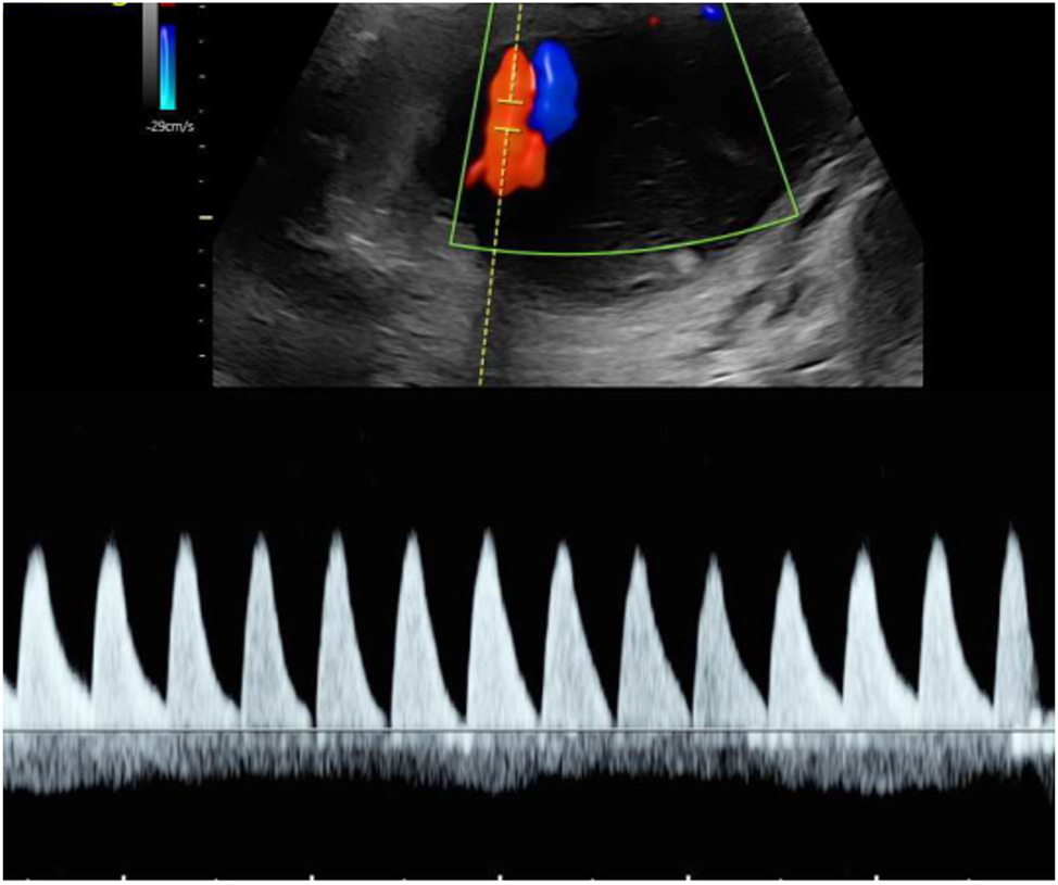Figure 7: 
Umbilical artery Doppler flow pattern in sFGR type 3 at 22 + 6 weeks of gestation. Demonstration of intermittent end-diastolic positive flow, absent flow and negative flow.