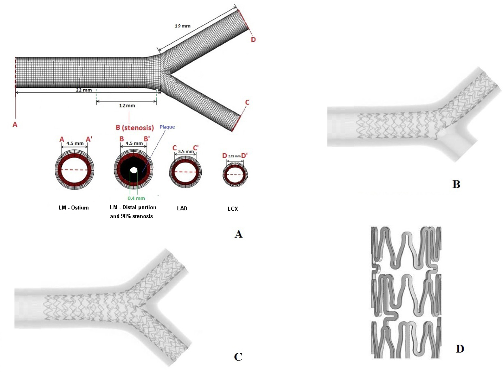 Figure 1 Left main coronary artery bifurcation model: A) model diameter and length; B) Appearance of the virtual implantation of Xience in provisional stenting fashion; C) Appearance of the virtual implantation of Xience in culotte fashion; D) Xience design and reconstruction.