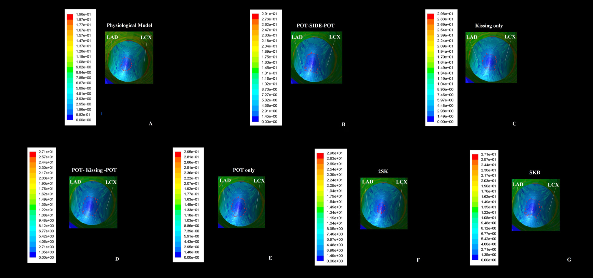 Figure 2 Computed flow dynamic representation of area of lower Wall Shear Stress forces at the carina site using the different post-dilation techniques in Provisional stenting: the area of Wall Shear Stress forces results smaller in kissing balloon and 2-step kissing balloon compared to the others.