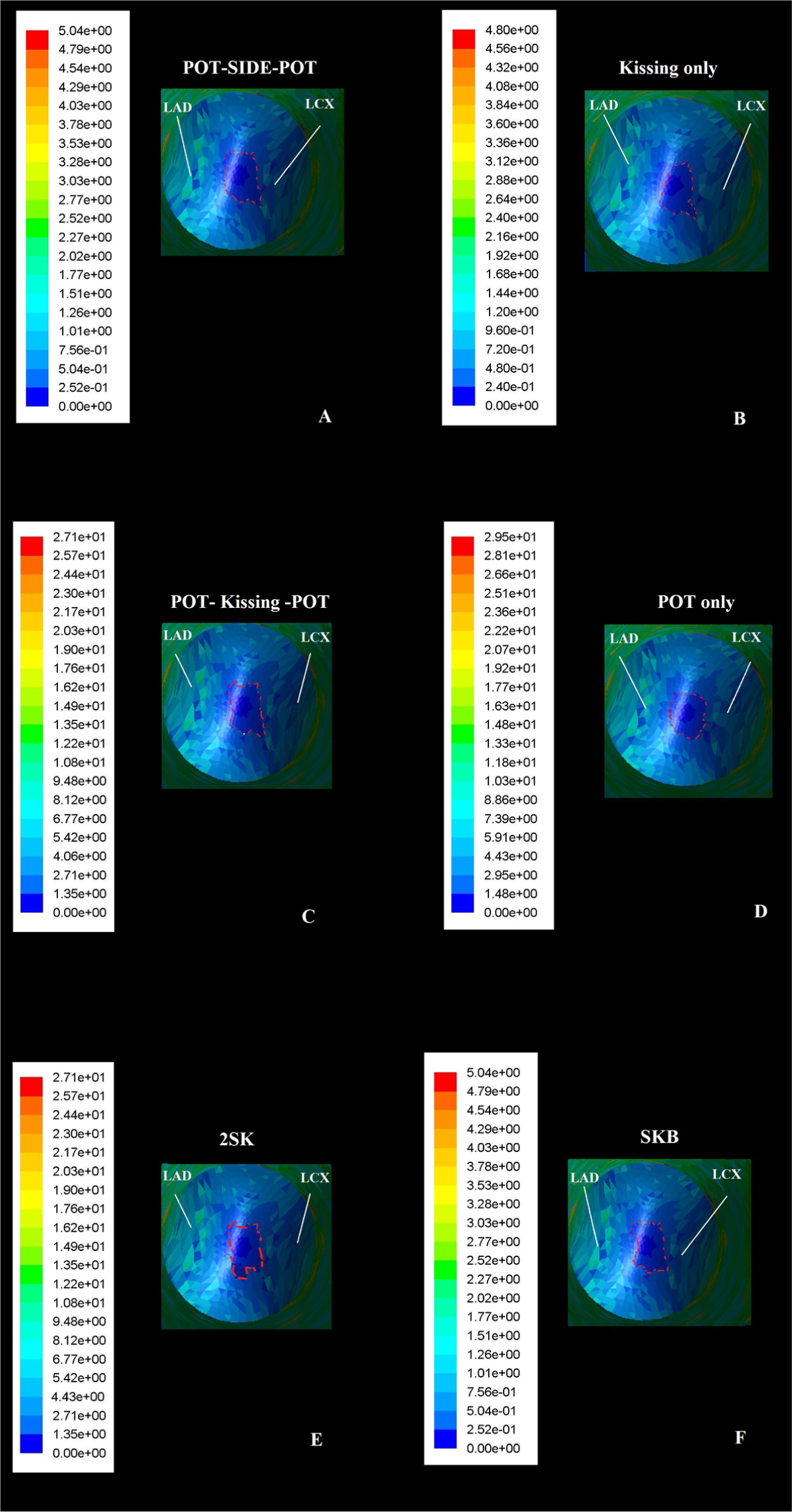 Figure 4 Computed flow dynamic representation of area of lower Wall Shear Stress forces at the carina site using the different post-dilation techniques in Culotte stenting: the area of Wall Shear Stress forces results smaller in POT-kissing balloon-POT and 2-steps kissing balloon compared to the others.