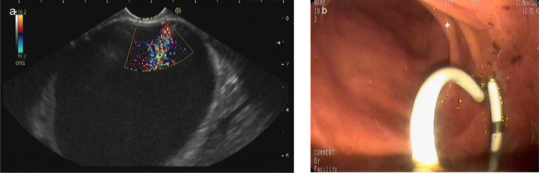 Figure 1 Endoscopic ultrasound-guided drainage process with plastic stent. (a) Pancreatic pseudocyst located at the body of pancreas; (b) a double-pigtail plastic stent was applied in the drainage.
