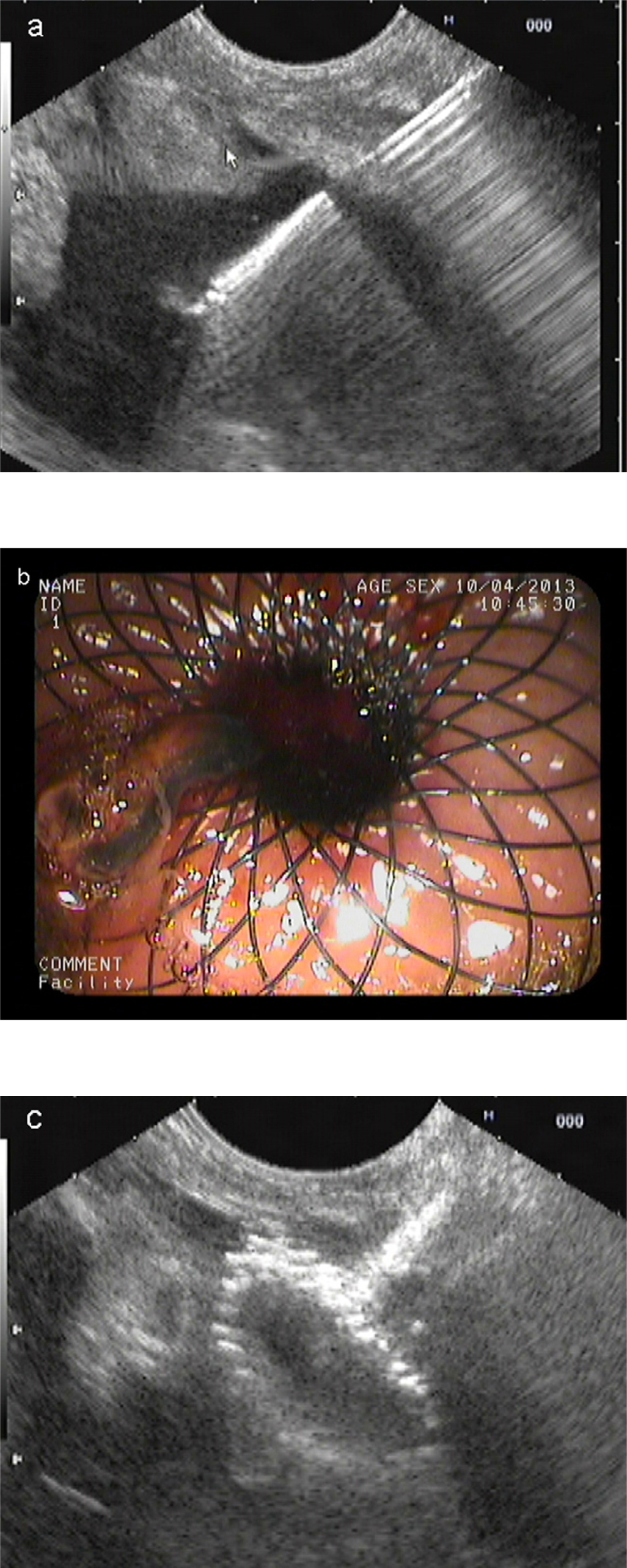 Figure 2 Endoscopic ultrasound (EUS)-guided drainage process with metal stent. (a) EUS-guided cyst puncture with needle; (b) endoscopic image of the metal stent; (c) EUS image of the metal stent.