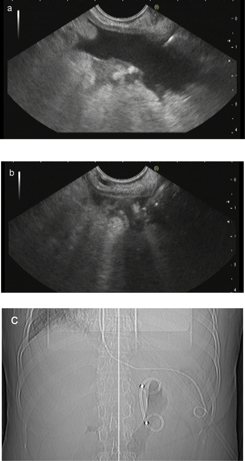 Figure 3 (a) Leakage of a large amount of cyst fluid into the abdominal cavity after the procedure; (b) endoscopic ultrasound-guided abdominal drainage with endoscopic nasobiliary drainage (ENBD); (c) X-ray image after the abdominal drainage.