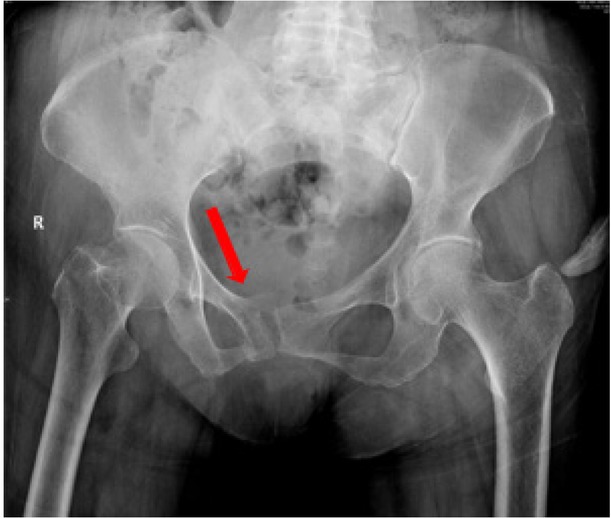 Figure 1 Pelvic X-ray showed mild displacement symphysis pubis fracture without dislocation of the joint.
