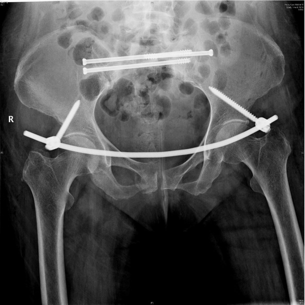 Figure 3 X-ray postoperation showed anterior pelvic ring internal fixator for symphysis pubis fracture combined iliosacral screws for sacrum fracture.