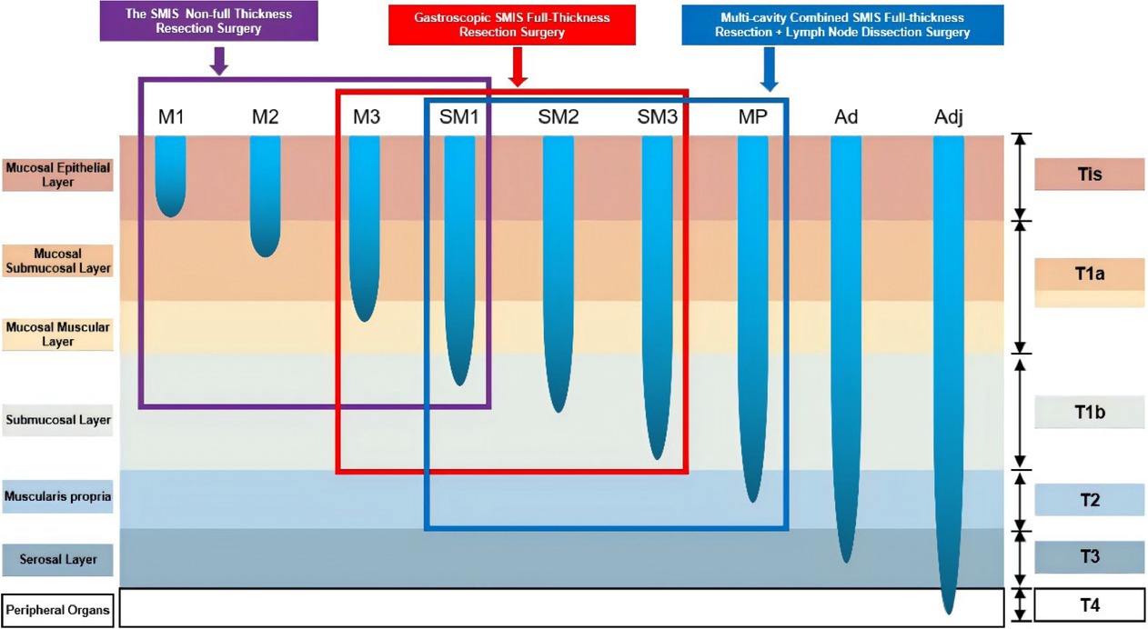 Figure 1 SMIS surgical selection strategy for early gastric cancer. SMIS, super minimally invasive surgery.