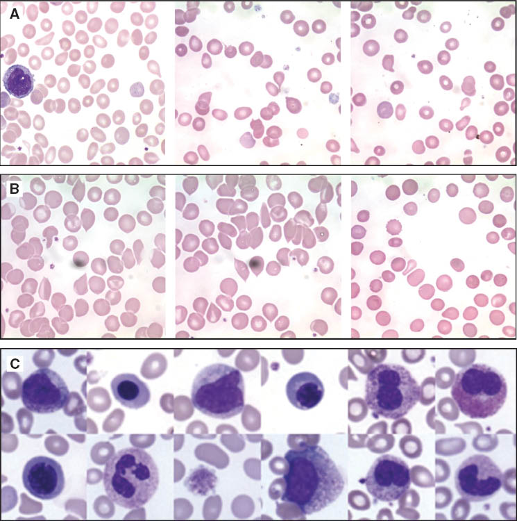 Figure 1 Teardrop red blood cells in the peripheral blood smear.(A) Genuine teardrop erythrocytes in a case of primary myelofibrosis (PMF) (Pappenheim, 100× magnification). (B) Artifacts: “False teardrops” by juxtaposition of several erythrocytes or teardrops with pointed ends, not typical of real dacryocytes (Pappenheim, 100× magnification). (C) Leukoerythroblastic changes in PMF with transition to AML. Leukocyte morphology in PMF with numerous early myeloid precursors, normoblasts and a giant platelet (Pappenheim, 100× magnification).