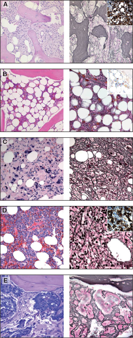 Figure 2 Diseases associated with myelofibrosis: typical changes in the bone marrow biopsy.(A) PMF: Numerous atypical megakaryocytes in clusters, highlighted by CD61 immunohistochemical staining (insert). End stage (stage III) myelofibrosis with dense, diffuse increase of both reticulin and collagen fibers and prominent osteosclerosis with irregular and deformed, widened trabeculae (H&E and Gordon, 40× lens). (B) Hypoplastic MDS with advanced myelofibrosis. [H&E, Gordon, CD34 (insert) 40× magnification]. (C) Megakaryocyte-rich MDS with associated myelofibrosis [H&E Gordon, CD61 (insert), 40× magnification]. (D) Acute megakaryoblastic leukemia (AML M7). Small, monomorphic blasts with megakaryocytic marker expression [H&E Gordon, CD61 (insert), 40× magnification]. (E) Bone marrow infiltration by prostate cancer cells; tumor cells arranged in glandular and cribriform patterns with displacement of normal hematopoiesis and increase of reticulin fibers as part of the tumor-associated stroma (PAS, Gordon, 40× magnification).