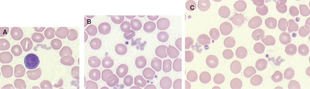 Abbildung 3 Mikroskopische Darstellung partikulärer Kryoglobuline mit Störung der Thrombozytenzählung bei drei verschiedenen Patienten.