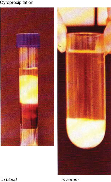 Figure 1: Cryoprecipitation in blood and serum.