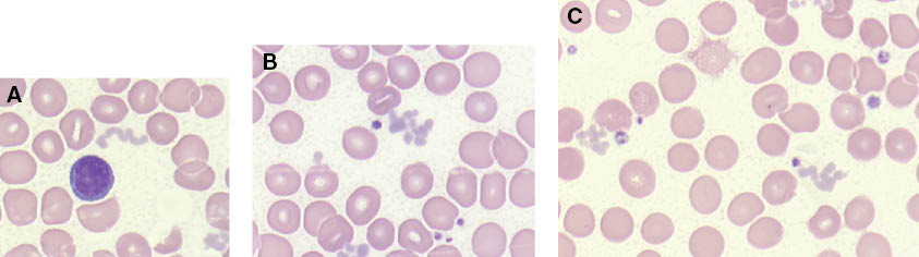 Figure 3: Microscopic representation of particulate cryoglobulins with interference of the platelet count in three different patients.