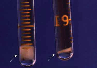 Figure 4: Quantification of cryoglobulins in cryocrit tubes according to Wintrobe to determine the cryocrit (so-called Wintrobe tubes).