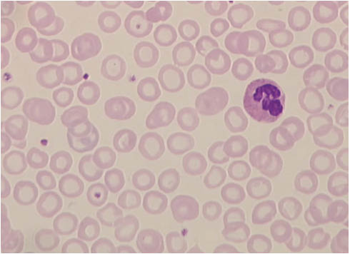 Abbildung 2: Ausstrich des peripheren Blutes bei einer Eisenmangelanämie.Die Erythrozyten sind kleiner als normale rote Blutkörperchen. Durch Mangel an Hämoglobin ist die zentrale Aufhellung größer als normal, die meisten Erythrozyten kommen als Ringformen, sogenannte Anulozyten zur Darstellung.