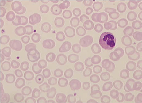 Figure 2: Peripheral blood film of a patient with an iron deficiency anemia.The erythrocytes are smaller than normal red blood cells. As a result of the lack of hemoglobin, there is an increase in central pallor, which occupies more than the normal approximate one-third of the red cell diameter. Most erythrocytes appear ring-shaped, known as anulocytes.