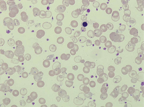 Figure 4: Smear of peripheral blood in the case of a transfusion-dependent β-thalassemia major.One sees an abundance of hypochromic anulocytes whose cell membrane is only slightly covered with hemoglobin, as well as individual target cells. Howell-Jolly bodies are present in some erythrocytes due to a splenectomy in the past, as are numerous Pappenheimer bodies (siderocytes), which indicate derangement of iron metabolism. Between the patient’s own erythrocytes, one can see transfused donor erythrocytes, one erythroblast and numerous platelets. Laboratory, see Table 4, patient 14.