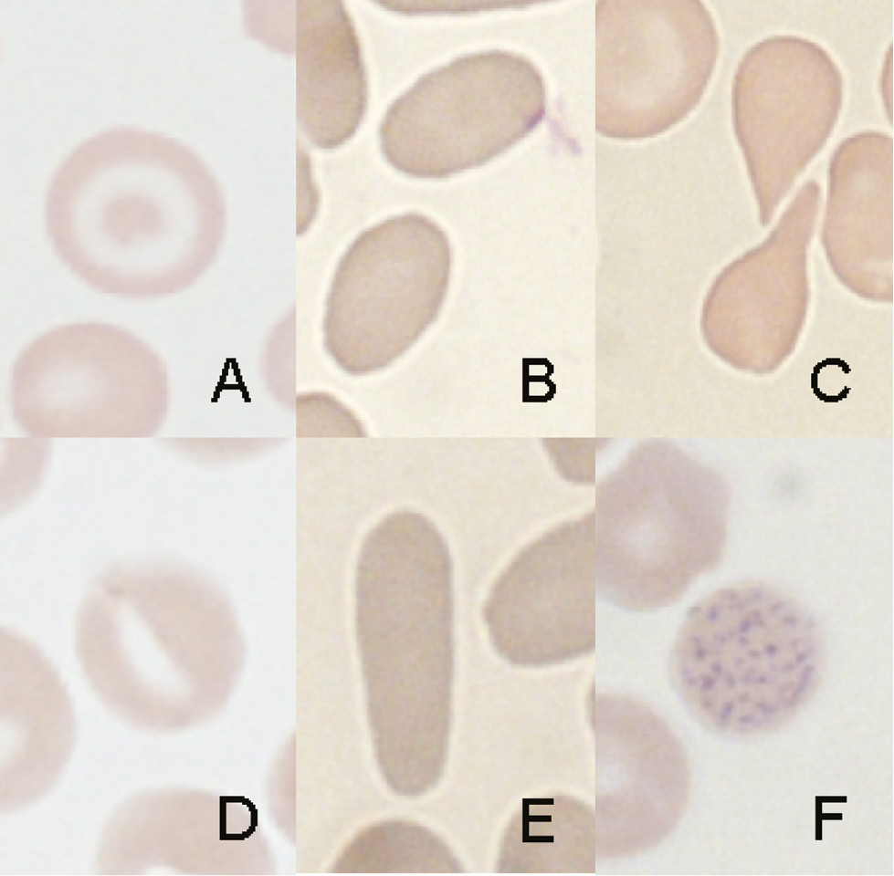 Figure 1: The most frequent red blood cell abnormalities in patients with β-thalassemia minor.A, target cell; B, ovalocyte; C, dacryocyte; D, stomatocyte; E, elliptocyte; F, basophilic stippling.