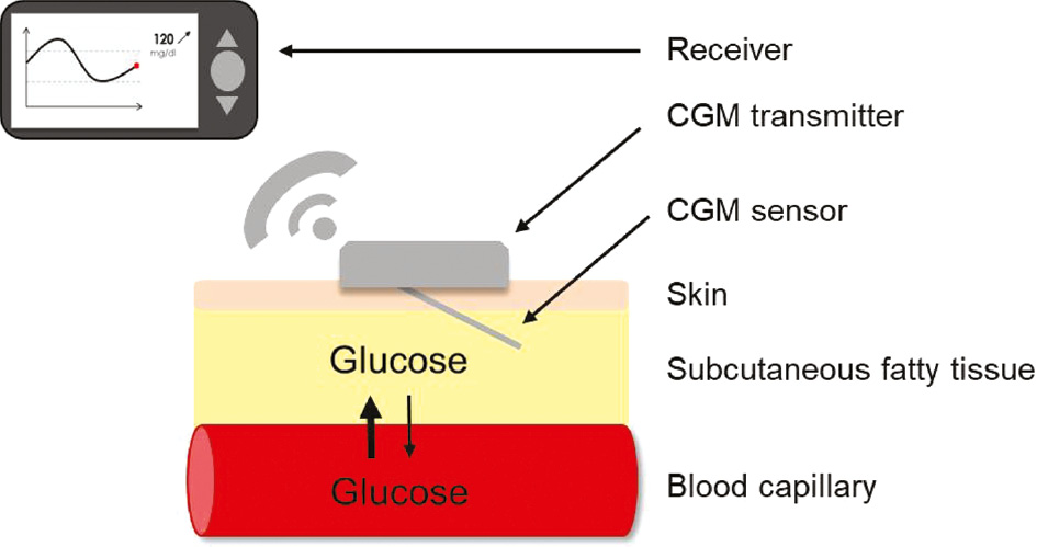 Figure 1: Components of a CGM system (scheme).