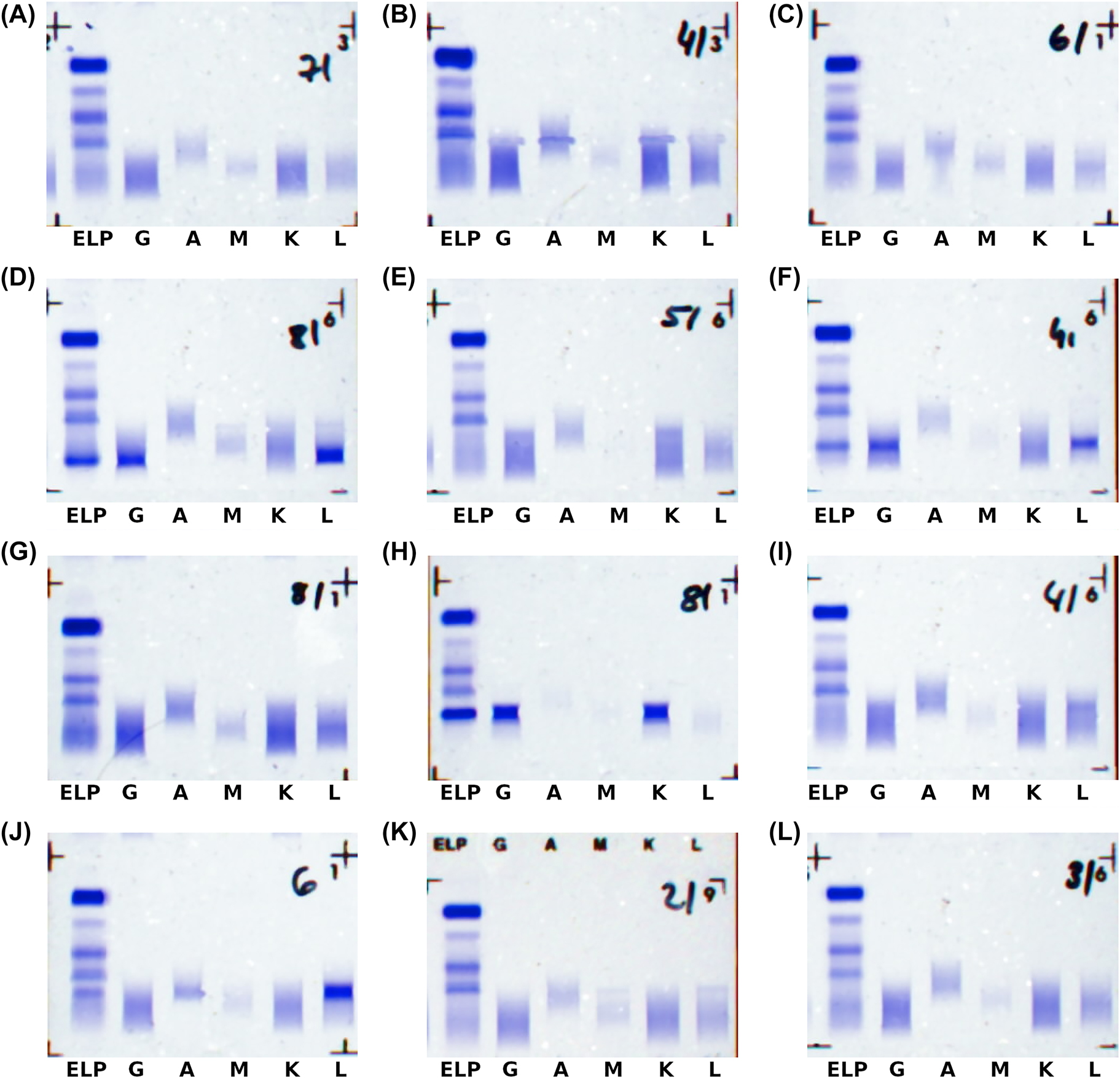 Figure 3: 
Examples where AI assessment and expert label deviate.
(A) Negative (assessment) instead of IgM-Kappa (label); (B) free chain (assessment) instead of IgG-Lambda (label), note the artefacts in the image; (C-E) bi-/oligoclonal (assessment) instead of the labels IgG-Lambda (C), IgG-Lambda (D), and IgG-Kappa (E); (F) IgG-Lambda (assessment) instead of IgG-Lambda + Lambda (label); (G) IgG-Lambda (assessment) instead of IgG-Kappa + Lambda (label); (H) IgG-Kappa (assessment) instead of biclonal IgG-Kappa (label); (I) IgG-Lambda (assessment) instead of single-lambda (label); (J) IgA-Lambda (assessment) instead of single-lambda (label); (K) IgG-Lambda (assessment) instead of inconclusive (label); (L) IgG-Kappa (assessment) instead of inconclusive (label).
