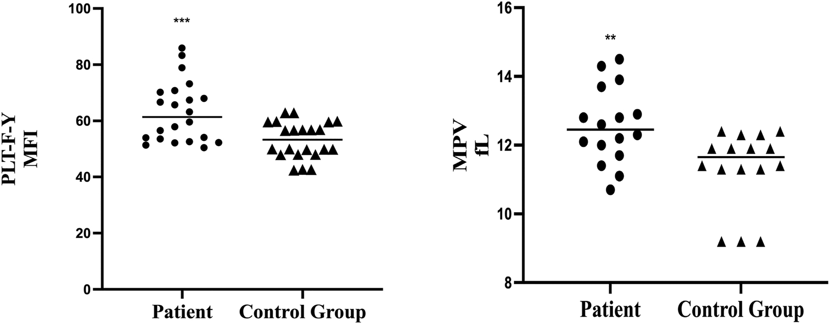 Figure 2: 
Comparison of patients and control group in values of PLT-F-Y and MPV. Values of PLT-F-Y and MPV were significantly higher in patient group.
