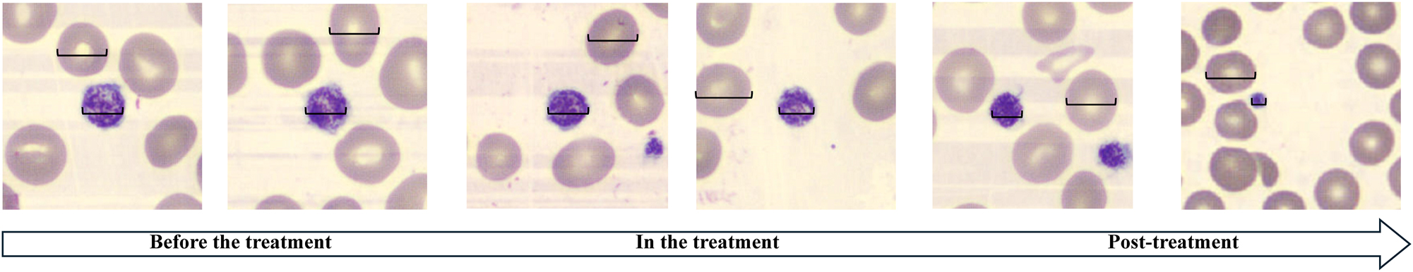 Figure 4: 
PLT size observation at different stages of neonatal sepsis. As the treatment progressed, the volume of PLT decreased from large to normal.
