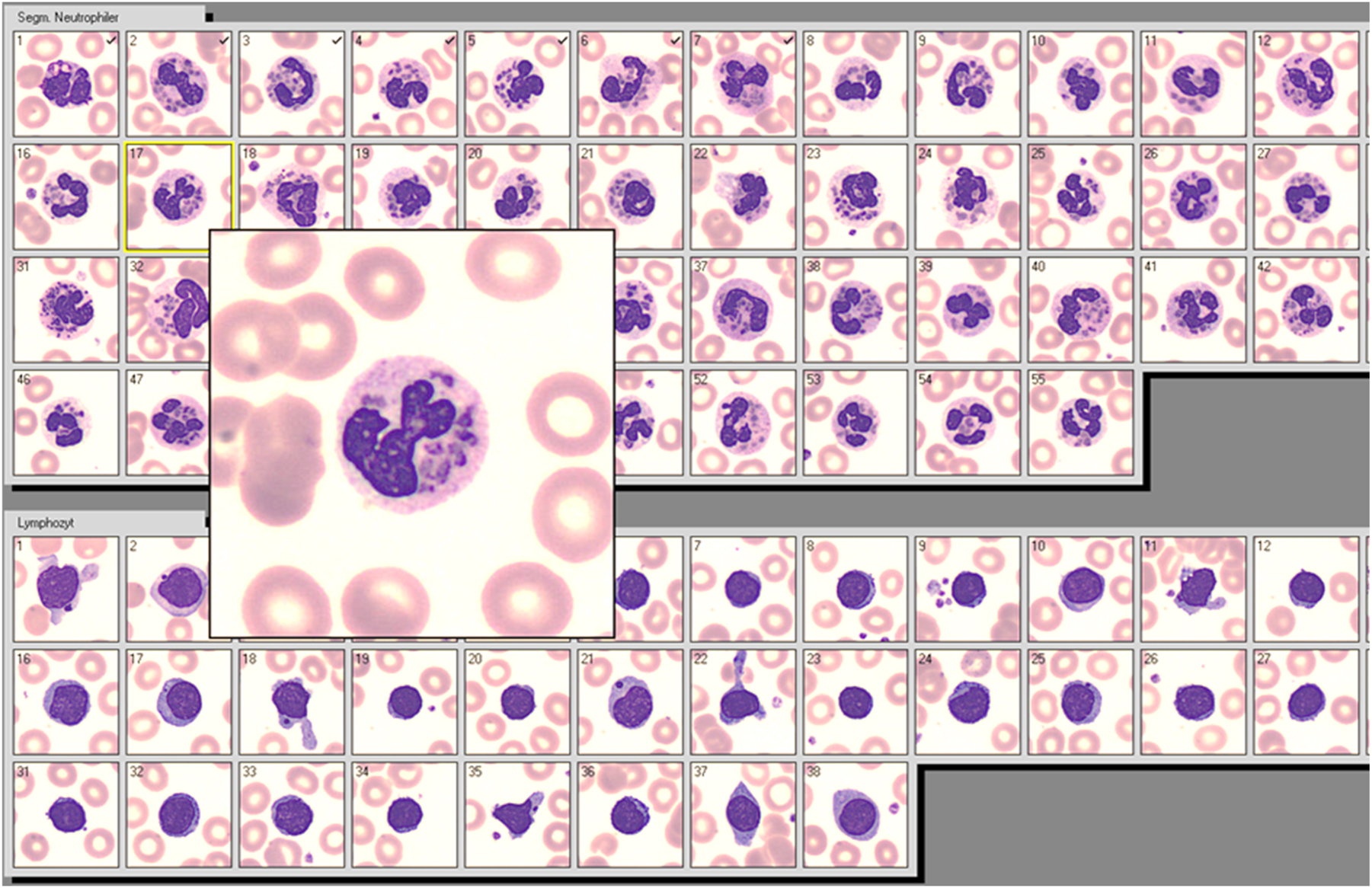 Figure 1: 
Neutrophils and lymphocytes from a patient with Chediak-Higashi-Syndrome showing cytoplasmatic aggregates of dysfunctional lysosomes.
