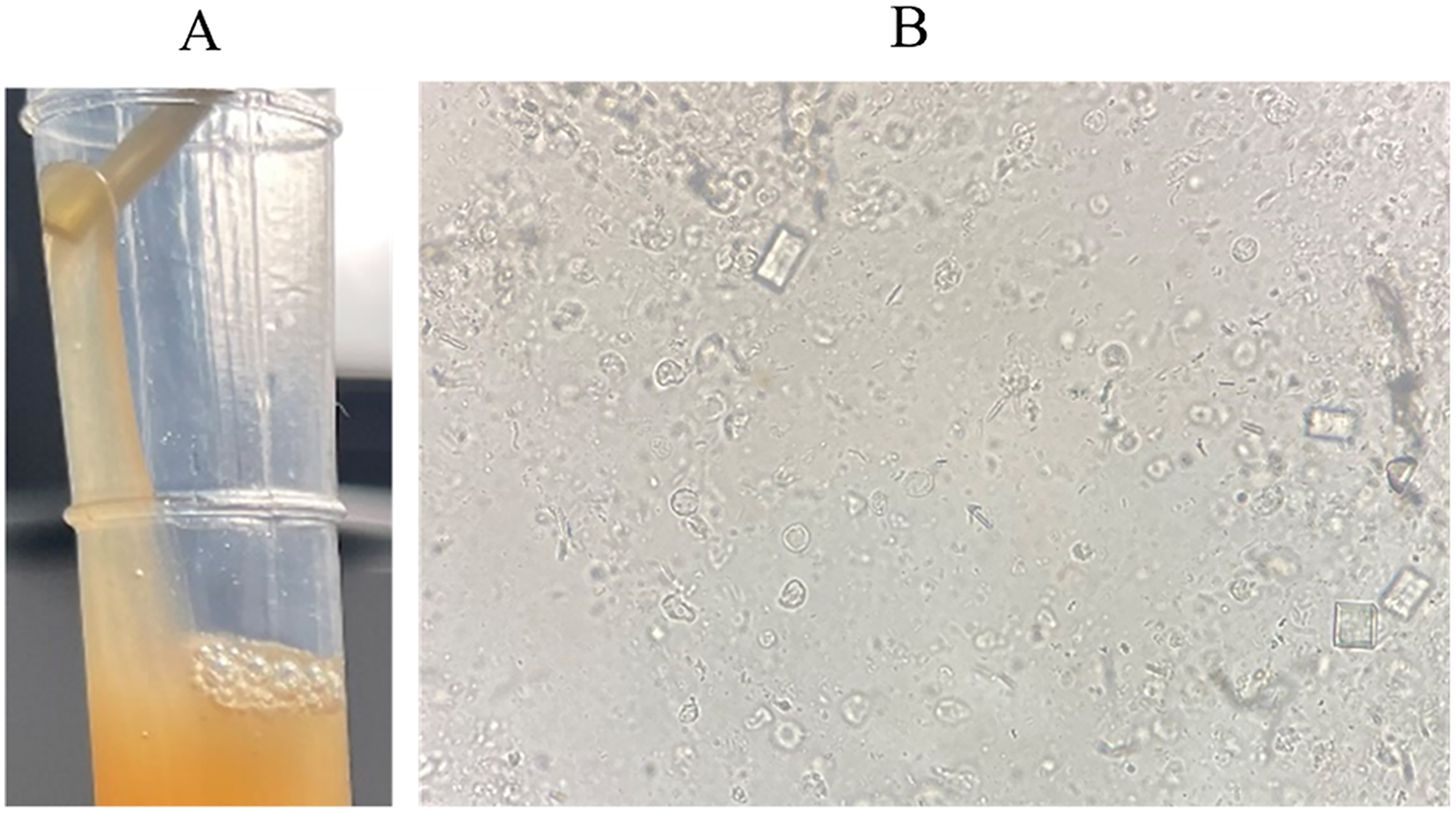 Figure 1: 
(A) Original urine sample. (B) Original urine smear (unstained, original magnification ×400).
