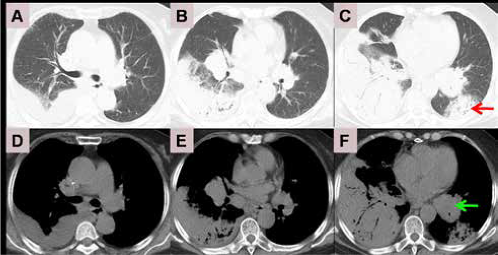 Figure 1 Initial chest computed tomography. Lung window: A B C; mediastinal window: D E F. Red arrow indicates reversed halo sign, and green arrow indicates low density area in left hilar mass.