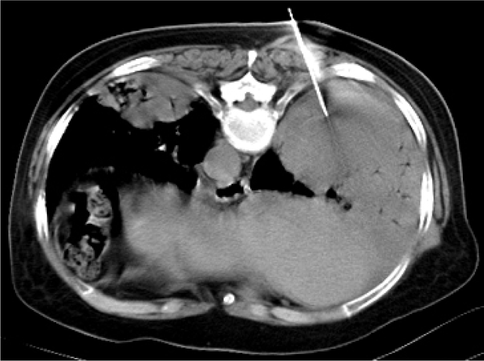 Figure 2 Computed tomography guided transthoracic core needle. Puncture needle is in the consolidation area of right lower lobe.