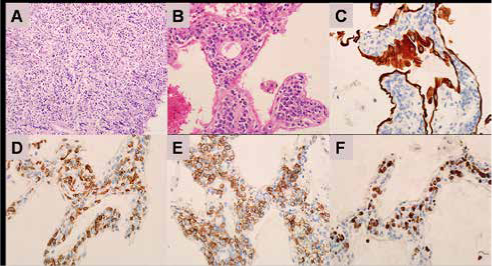 Figure 3 Hematoxylin and eosin (H&E) staining and immunohisto-chemical staining. A: Alveolar septal broadens, and tumor cells infiltrate (HEx100); B: The tumor cells are large and rich in cytoplasm, the karyotype is slightly irregular, and nucleolus is visible (HEx400); C: immunohistochemical staining for cytokeratin (CK) (x400); D: immunohistochemical staining for CD-5 (x400); immunohistochemical staining for CD20 (x400); immunohistochemical staining for Ki-67 (x400).