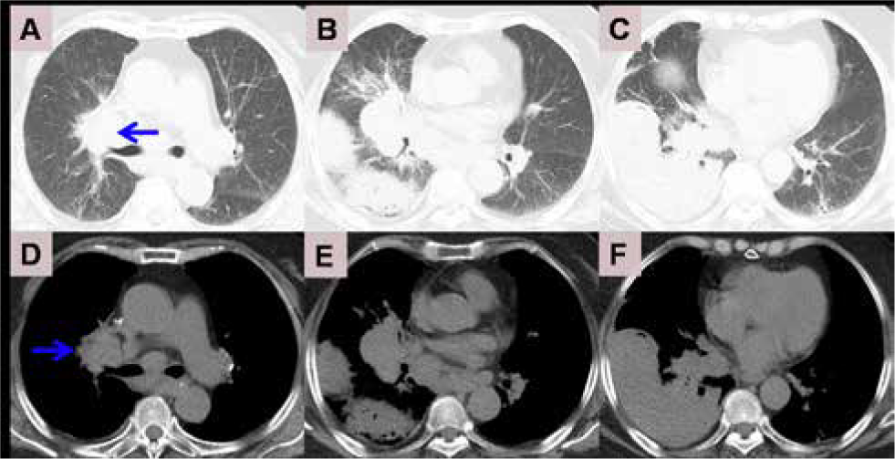 Figure 4 Chest computed tomography after 6 cycles of chemotherapy. A B C; mediastinal window: D E F. Blue arrow indicates newly emerging mass.