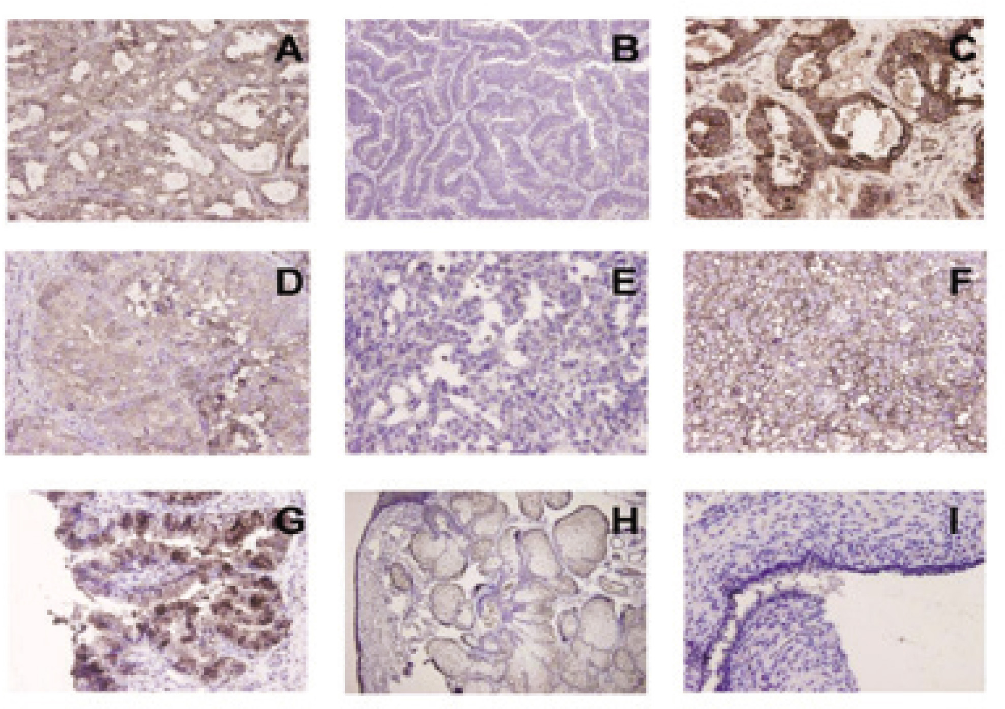 Figure 3 Expression of HE4 in ovarian tumor tissues Immunohistochemical staining of HE4 in serous ovarian cancer (Fig3A, ×400); mucous ovarian cancer (Fig3B, ×400); hyaline cell cancer (Fig3C, ×400); ovarian adenoendometrio carcinoma (Fig3D, ×400); corpus luteum cyst tumor (Fig3E, ×400); germ cell tumor (Fig3F, ×400); borderline ovarian tumor (Fig3G, ×400); ovarian benign tumor (Fig3H, ×400); ovarian endometriosis cyst (Fig 3I, ×400).