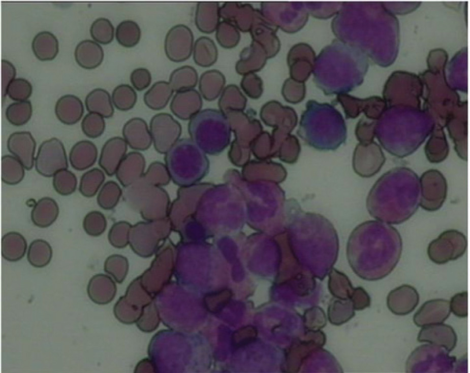 Figure 1 Bone marrow smear shows typical chronic