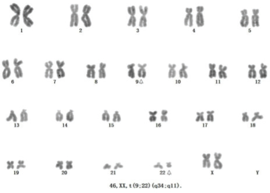 Figure 2 Typical chronic myeloid leukemia chromosome changes46, XX, t (9; 22) (q34; q11)
