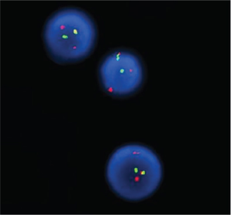 Figure 3 Typical chronic myeloid leukemia gene mutation: bcr-ablfusion gene by FISH array