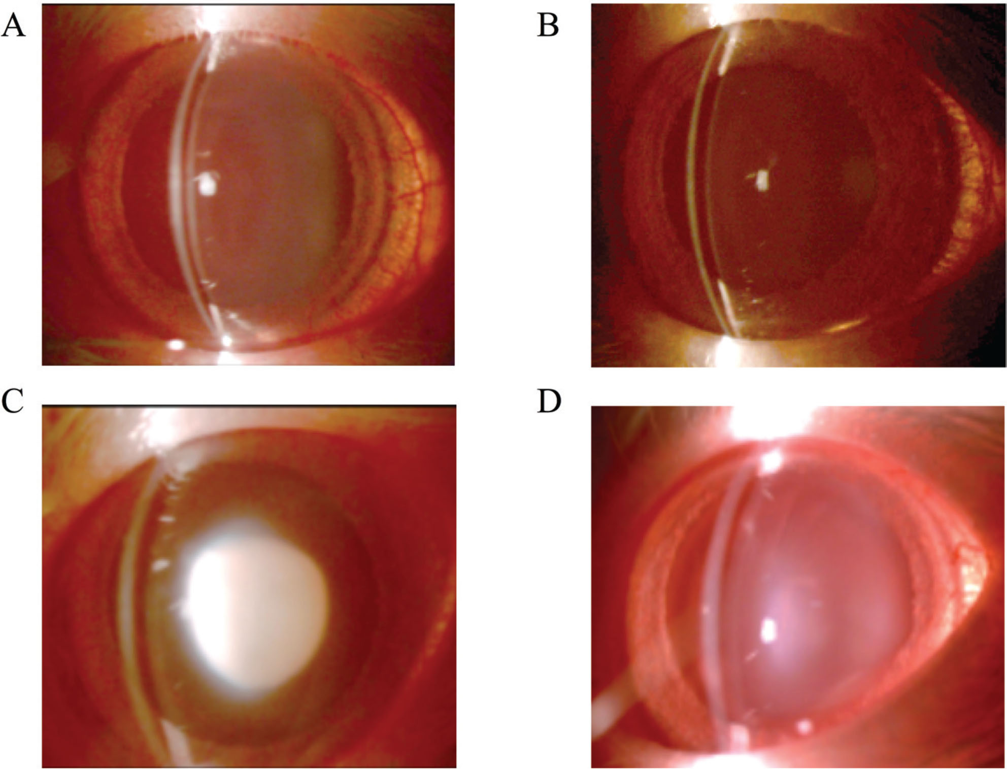 Figure 1 Effect of hespertin for cataractgenesis induced selenite administration. Groups G1 and G2 were injected with vehicle (control) and groups G3 and G4 were injected with sodium selenite subcutaneously into 13-day-old rats (Day 0). Hesperetein was administered to groups G2 and G4 subcutaneously in 13-, 14-, and 15-day-old rats (Day 0, 1, and 2, respectively). All lenses are taken 6 days after selenite or vehicle administration. (A) G1: no selenite and no hesperetin treatment. (B) G2: no selenite and hesperetin treatment. (C) G3: selenite treatment and no hesperetin treatment. (D) G4: selenite and hesperetin treatment. Rats in groups G1 and G2 had transparent lenses. Rats in the G3 group had a mature nuclear cataract, while those in group G4 had milder forms of nuclear cataracts.