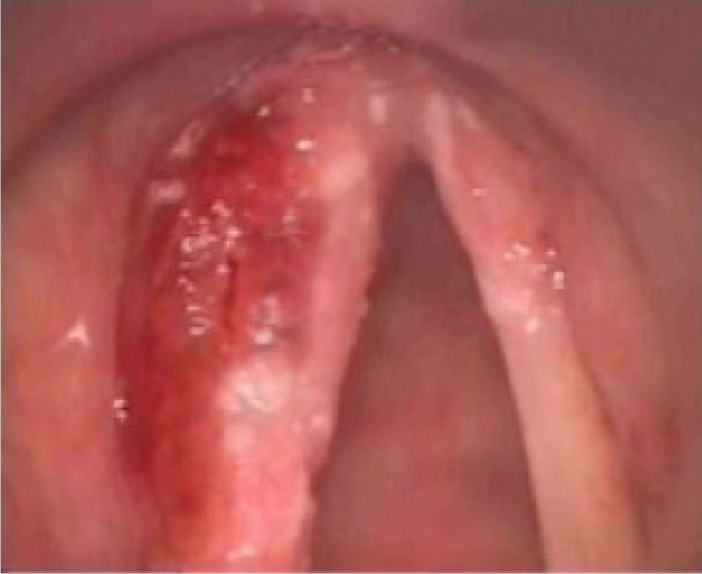 Figure 1 Fibrolaryngoscopy: red-violaceous nodular lesion of the left vocal cord and anterior commissure.