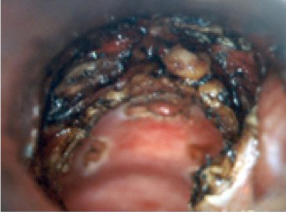 Figure 2 Microlaryngoscopic vision of the operative field after laser cordectomy.