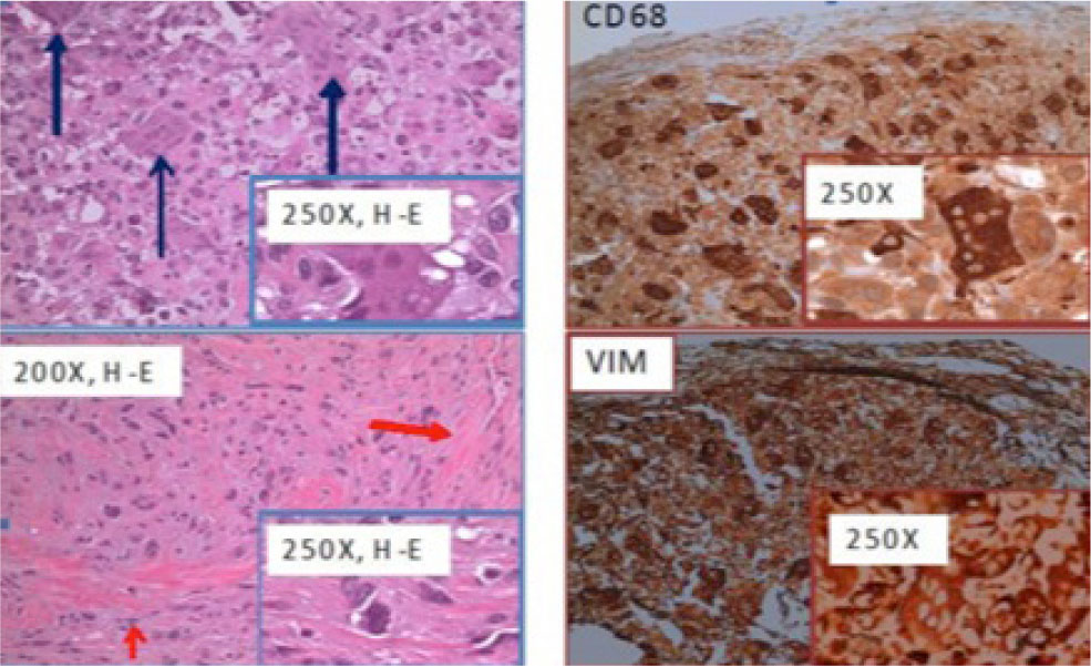 Figure 3 Microscopic evaluation showed a lesion mostly formed of spindle-shaped malignant cells arranged in a fascicular/stori-form pattern of growth, with several highly pleomorphic elements, was observed in the corion. (green arrow). Moreover, a significant number of osteoclast-like giant-cells, with hyperchromatic and slightly atypical nuclei, were found (blue arrows). A focal collagen deposition, consisting of bundles of fibrillar eosinophilic material, was associated (red arrows). At the immunohistochemical exam, the lesion showed a strong and diffuse positivity to vimentin and a mild reactivity to CD68, more prominently in the giant cells counterpart. Finally, a diagnosis of malignant fibrous histiocytoma (MFH) was made.