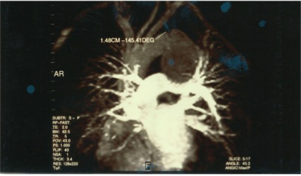 Figure 1 Angio MRI: presence of pseudo-aneurysm of the descending thoracic aorta compressing the bronchus of the left and probably the left recurrent nerve. At the level of the origin of the descending thoracic enjoying a break from the intimate closed chest trauma.