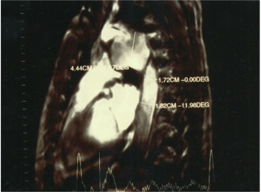 Figure 2 Angio MRI: Evidence of the relationship between the vascular intimal rupture post-traumatic descending thoracic aorta and the pseudo-aneurysm formation.