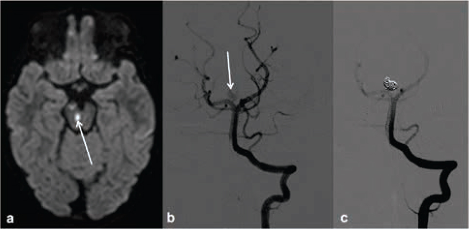 Figure 1 Unusual case of a three year old girl with an incidentally found partially thrombosed intracranial aneurysm. The girl presented with oculomotoric palsies due to small brain stem and mesencephalic (arrow) infarctions found in diffusion weighted MRI (a). Digital subtraction angiography with injection of the left vertebral artery shows the aneurysm of the right proximal posterior cerebral artery (arrow) prior (b) and after (c) endovascular occlusion with platinum coils.