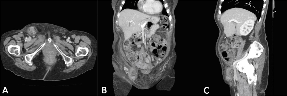 Figure 1 Case Report 1Contrast-enhanced CT of the abdomen. (A) Axial view: tubular structure containing gas within the femoral hernia. (B) Coronal and (C) sagittal views: tubular structure extending from the caecal base.