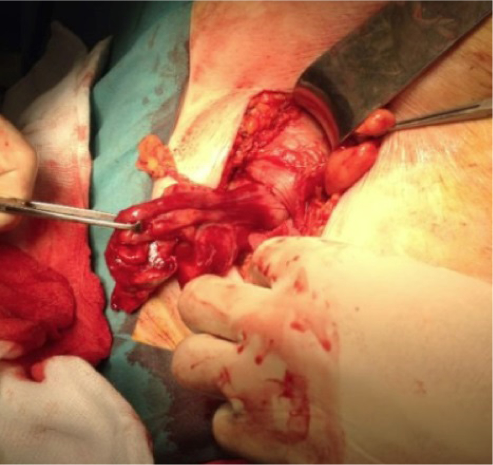 Figure 2 Case Report 1 Inflamed appendix inside the femoral hernia sac.