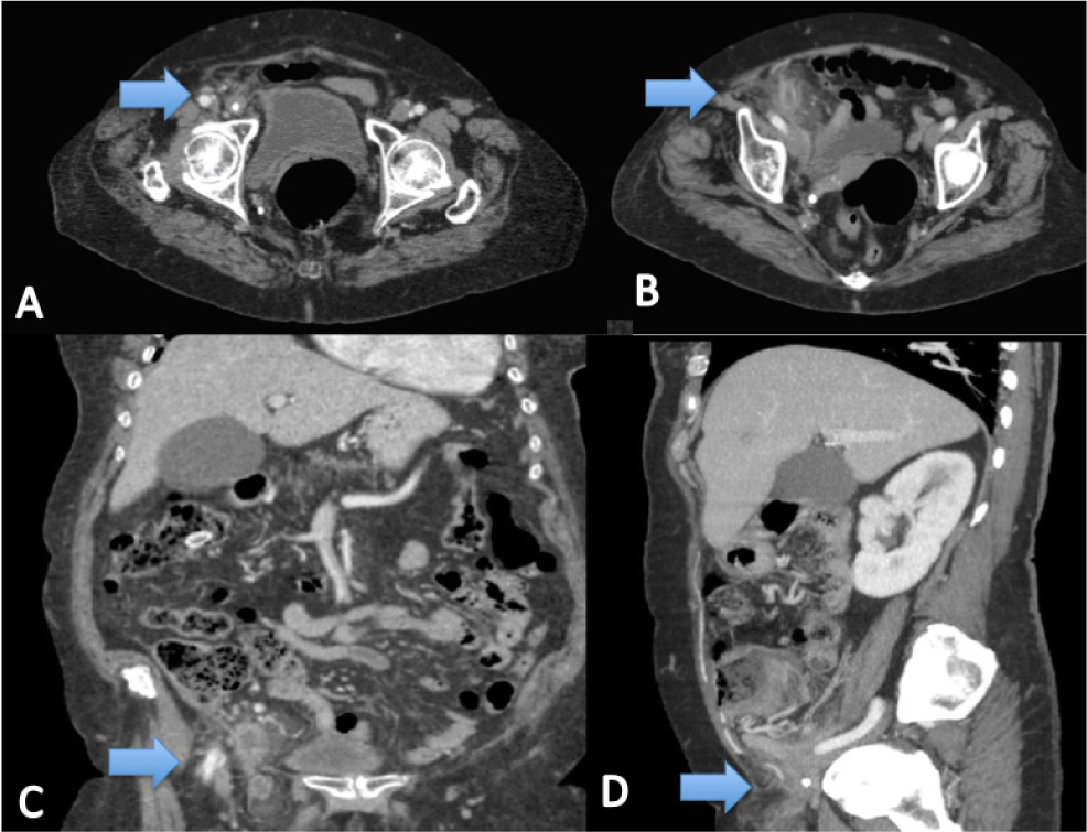Figure 3 A, B, C, D Case Report 2. CT images Arrow: Appendix